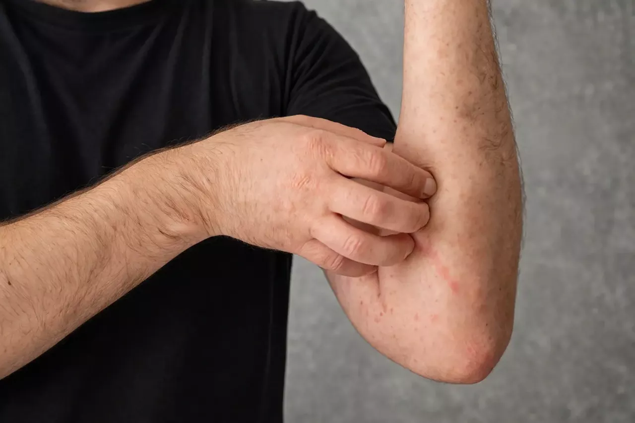 Что делать, если аллергия на антибиотики не дает нормально лечиться – пути решения проблемы